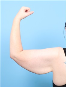 Arm Lift Before Photo by Lauren Daly, MD; ,  - Case 50285
