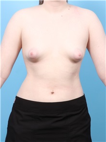 Breast Augmentation Before Photo by Lauren Daly, MD; ,  - Case 50286