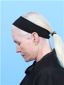 Facelift After Photo by Lauren Daly, MD; ,  - Case 50288