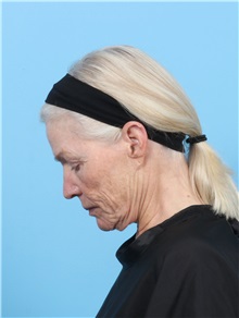 Facelift Before Photo by Lauren Daly, MD; ,  - Case 50288