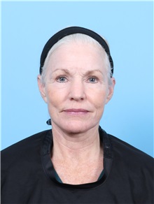 Facelift After Photo by Lauren Daly, MD; ,  - Case 50288