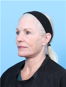 Facelift After Photo by Lauren Daly, MD; ,  - Case 50288