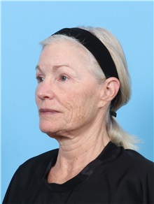 Facelift Before Photo by Lauren Daly, MD; ,  - Case 50288