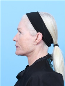Facelift After Photo by Lauren Daly, MD; ,  - Case 50288