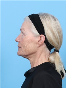 Facelift Before Photo by Lauren Daly, MD; ,  - Case 50288