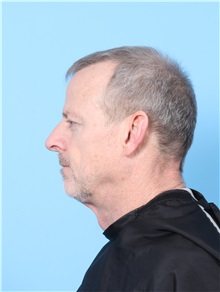 Eyelid Surgery After Photo by Lauren Daly, MD; Folsom, CA - Case 50716