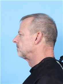 Eyelid Surgery Before Photo by Lauren Daly, MD; Folsom, CA - Case 50716