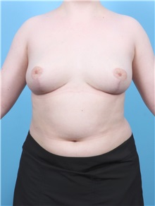 Breast Reduction After Photo by Lauren Daly, MD; Folsom, CA - Case 50717