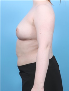 Breast Reduction After Photo by Lauren Daly, MD; Folsom, CA - Case 50717