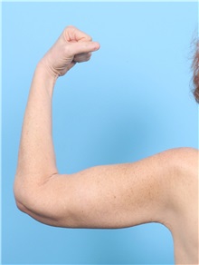 Arm Lift After Photo by Lauren Daly, MD; Folsom, CA - Case 50719