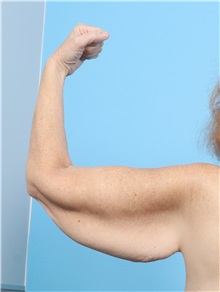 Arm Lift Before Photo by Lauren Daly, MD; Folsom, CA - Case 50719