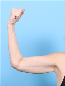 Arm Lift After Photo by Lauren Daly, MD; Folsom, CA - Case 50719