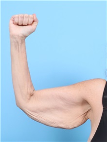 Arm Lift Before Photo by Lauren Daly, MD; Folsom, CA - Case 50719