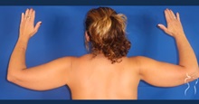 Arm Lift After Photo by Kristopher Day, MD, FACS; Bellevue, WA - Case 49869 Arm Lift After Photo by Kristopher Day, MD, FACS; Bellevue, WA - Case 49869