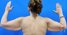 Arm Lift Before Photo by Kristopher Day, MD, FACS; Bellevue, WA - Case 49869 Arm Lift Before Photo by Kristopher Day, MD, FACS; Bellevue, WA - Case 49869