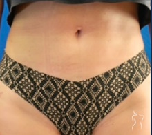 Liposuction After Photo by Kristopher Day, MD, FACS; Bellevue, WA - Case 49888 Liposuction After Photo by Kristopher Day, MD, FACS; Bellevue, WA - Case 49888