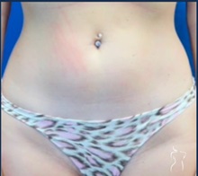 Liposuction Before Photo by Kristopher Day, MD, FACS; Bellevue, WA - Case 49888 Liposuction Before Photo by Kristopher Day, MD, FACS; Bellevue, WA - Case 49888