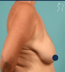 Breast Lift Before Photo by Kristopher Day, MD, FACS; Bellevue, WA - Case 49885