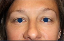 Eyelid Surgery After Photo by Kristopher Day, MD, FACS; Bellevue, WA - Case 49898 Eyelid Surgery After Photo by Kristopher Day, MD, FACS; Bellevue, WA - Case 49898