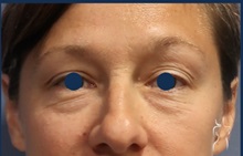 Eyelid Surgery Before Photo by Kristopher Day, MD, FACS; Bellevue, WA - Case 49898 Eyelid Surgery Before Photo by Kristopher Day, MD, FACS; Bellevue, WA - Case 49898