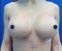 Breast Implant Revision After Photo by Kristopher Day, MD, FACS; Bellevue, WA - Case 49892 Breast Implant Revision After Photo by Kristopher Day, MD, FACS; Bellevue, WA - Case 49892