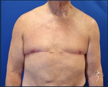 Body Contouring After Photo by Kristopher Day, MD, FACS; Bellevue, WA - Case 49879 Body Contouring After Photo by Kristopher Day, MD, FACS; Bellevue, WA - Case 49879