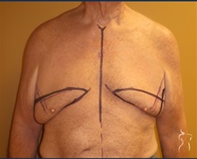 Body Contouring Before Photo by Kristopher Day, MD, FACS; Bellevue, WA - Case 49879 Body Contouring Before Photo by Kristopher Day, MD, FACS; Bellevue, WA - Case 49879
