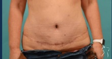 Tummy Tuck After Photo by Kristopher Day, MD, FACS; Bellevue, WA - Case 49882 Tummy Tuck After Photo by Kristopher Day, MD, FACS; Bellevue, WA - Case 49882