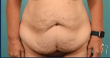 Tummy Tuck Before Photo by Kristopher Day, MD, FACS; Bellevue, WA - Case 49882 Tummy Tuck Before Photo by Kristopher Day, MD, FACS; Bellevue, WA - Case 49882