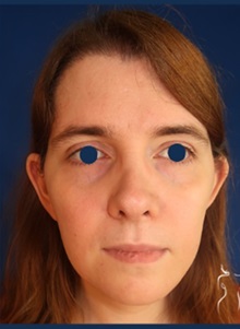 Facial Feminization After Photo by Kristopher Day, MD, FACS; Bellevue, WA - Case 49897 Facial Feminization After Photo by Kristopher Day, MD, FACS; Bellevue, WA - Case 49897