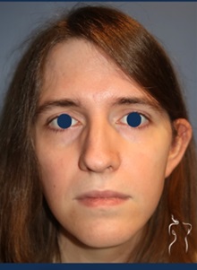 Facial Feminization Before Photo by Kristopher Day, MD, FACS; Bellevue, WA - Case 49897 Facial Feminization Before Photo by Kristopher Day, MD, FACS; Bellevue, WA - Case 49897