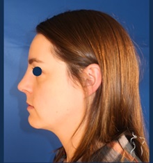 Rhinoplasty After Photo by Kristopher Day, MD, FACS; Bellevue, WA - Case 49875 Rhinoplasty After Photo by Kristopher Day, MD, FACS; Bellevue, WA - Case 49875