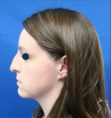 Rhinoplasty Before Photo by Kristopher Day, MD, FACS; Bellevue, WA - Case 49875 Rhinoplasty Before Photo by Kristopher Day, MD, FACS; Bellevue, WA - Case 49875