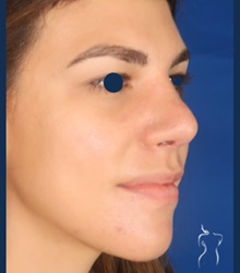 Rhinoplasty After Photo by Kristopher Day, MD, FACS; Bellevue, WA - Case 49899 Rhinoplasty After Photo by Kristopher Day, MD, FACS; Bellevue, WA - Case 49899