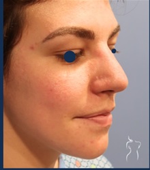 Rhinoplasty Before Photo by Kristopher Day, MD, FACS; Bellevue, WA - Case 49899 Rhinoplasty Before Photo by Kristopher Day, MD, FACS; Bellevue, WA - Case 49899
