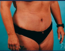 Tummy Tuck After Photo by Kristopher Day, MD, FACS; Bellevue, WA - Case 49880