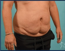 Tummy Tuck Before Photo by Kristopher Day, MD, FACS; Bellevue, WA - Case 49880