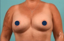 Breast Augmentation After Photo by Kristopher Day, MD, FACS; Bellevue, WA - Case 49884 Breast Augmentation After Photo by Kristopher Day, MD, FACS; Bellevue, WA - Case 49884