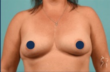 Breast Augmentation Before Photo by Kristopher Day, MD, FACS; Bellevue, WA - Case 49884 Breast Augmentation Before Photo by Kristopher Day, MD, FACS; Bellevue, WA - Case 49884