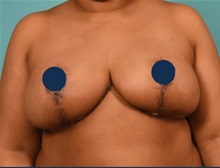 Breast Reduction After Photo by Kristopher Day, MD, FACS; Bellevue, WA - Case 49887 Breast Reduction After Photo by Kristopher Day, MD, FACS; Bellevue, WA - Case 49887