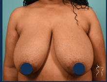 Breast Reduction Before Photo by Kristopher Day, MD, FACS; Bellevue, WA - Case 49887 Breast Reduction Before Photo by Kristopher Day, MD, FACS; Bellevue, WA - Case 49887