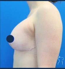 Breast Augmentation After Photo by Kristopher Day, MD, FACS; Bellevue, WA - Case 49876 Breast Augmentation After Photo by Kristopher Day, MD, FACS; Bellevue, WA - Case 49876