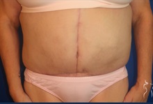 Tummy Tuck After Photo by Kristopher Day, MD, FACS; Bellevue, WA - Case 49893
