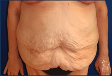 Tummy Tuck Before Photo by Kristopher Day, MD, FACS; Bellevue, WA - Case 49893