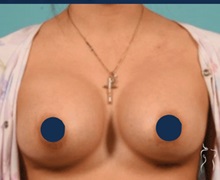 Breast Augmentation After Photo by Kristopher Day, MD, FACS; Bellevue, WA - Case 49878 Breast Augmentation After Photo by Kristopher Day, MD, FACS; Bellevue, WA - Case 49878