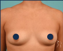 Breast Augmentation Before Photo by Kristopher Day, MD, FACS; Bellevue, WA - Case 49878 Breast Augmentation Before Photo by Kristopher Day, MD, FACS; Bellevue, WA - Case 49878