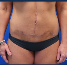 Body Lift After Photo by Kristopher Day, MD, FACS; Bellevue, WA - Case 49881 Body Lift After Photo by Kristopher Day, MD, FACS; Bellevue, WA - Case 49881