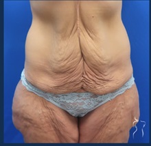 Body Lift Before Photo by Kristopher Day, MD, FACS; Bellevue, WA - Case 49881 Body Lift Before Photo by Kristopher Day, MD, FACS; Bellevue, WA - Case 49881