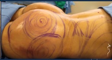 Buttock Lift with Augmentation After Photo by Kristopher Day, MD, FACS; Bellevue, WA - Case 49883 Buttock Lift with Augmentation After Photo by Kristopher Day, MD, FACS; Bellevue, WA - Case 49883
