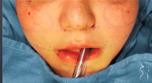 Cheek Reduction After Photo by Kristopher Day, MD, FACS; Bellevue, WA - Case 49886 Cheek Reduction After Photo by Kristopher Day, MD, FACS; Bellevue, WA - Case 49886